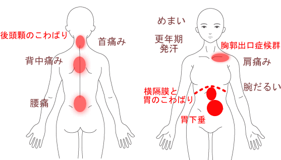更年期症状（発汗、めまい）、首肩背中などの痛み　改善症例説明図