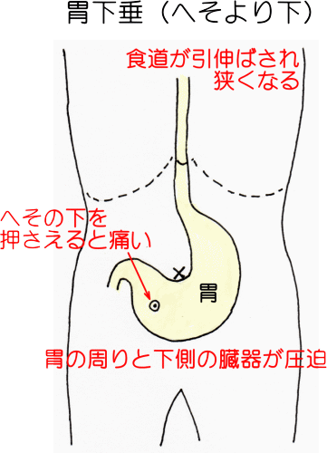 下垂した胃腸の説明図