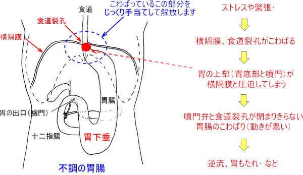 胃下垂などが原因で不調になっている胃腸の状態を表すイラスト