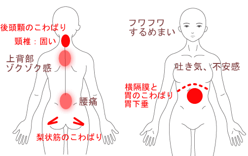 フワフワめまい、吐き気、パニックなどの改善症例説明図