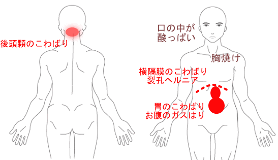 食道 裂孔 ヘルニア 筋 トレ